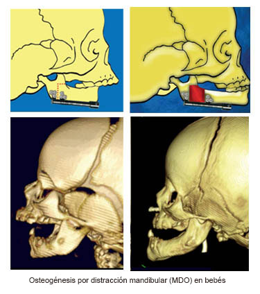 https://cribsandboxes.store/SiteCollectionImages/Infant_Mandibular_Distraction_Osteogenesis_es.jpg