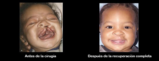 https://cribsandboxes.store/SiteCollectionImagesArticleImages/CleftbeforeAfter_Baby_es.jpg