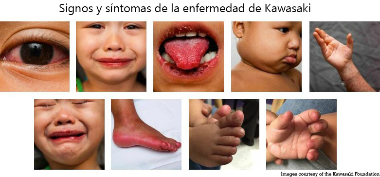 https://cribsandboxes.store/SiteCollectionImagesArticleImages/Signs_Symptoms_Kawasaki_Disease_es.jpg