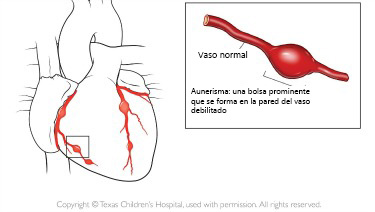 https://cribsandboxes.store/SiteCollectionImagesArticleImages/aneurysm_texaschildrens_es.jpg