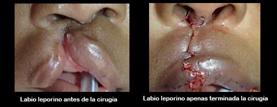 https://cribsandboxes.store/SiteCollectionImagesArticleImages/cleftLipBeforeAfter2_es.jpg