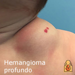 Hemangioma profundo